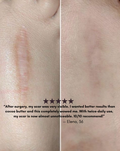 Gleama – Silicone Scar Stick